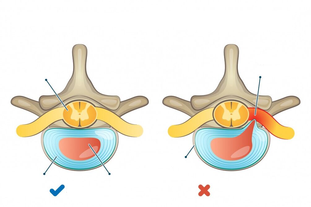 Intervertebral discs - one healthy, the other with a hernia