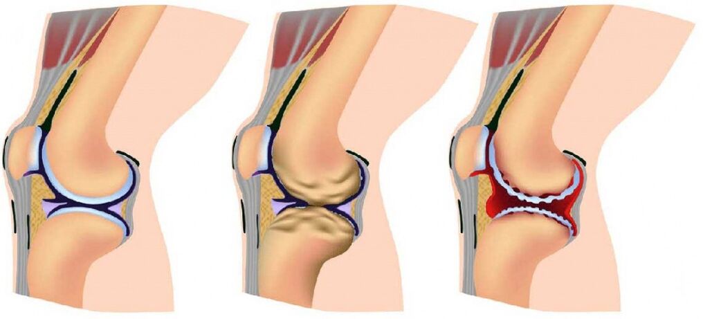 Affected by a healthy combination and arthrosis