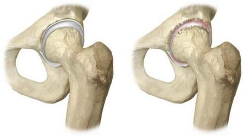 healthy and arthrosis-affected hip joint